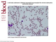 Passenger lymphocyte syndrome after lung transplant