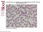 Sitosterolemia's stomatocytosis and macrothrombocytopenia