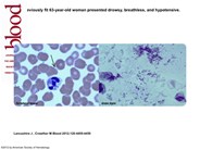 Blood smear: fulminant pneumococcal bacteremia