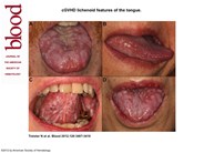 cGVHD lichenoid features of the tongue