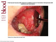 cGVHD of the buccal mucosa