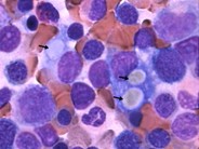 Multiple Myeloma - 3.