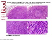 Histopathologic features of HIV MCD