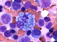 Multiple Myeloma 5.