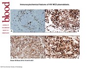 Immunocytochemical features of HIV MCD plasmablasts.