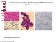 Histologic and immunocytochemical features of posttransplantation HHV8-related neoplastic diseases