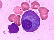 Multiple Myeloma - 6.