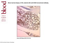 Bone marrow biopsy in HCL stained with anti-CD20 monoclonal antibody