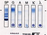 Multiple Myeloma - 8.