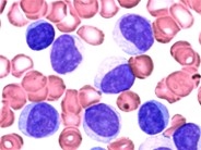 T Cell Prolymphocytic Leukemia 1