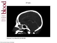 CT scan. Sagittal plane demonstrating sagittal sinus in APL