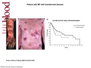 MF with transformed disease