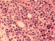 T-cell Prolymphocytic Leukemia - 6.