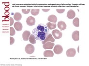 Human granulocytic anaplasmosis