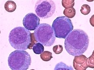 Acute myeloid leukemia with the t(8;21)(q22;22)