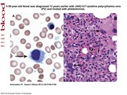 leukemia cells vs normal cells