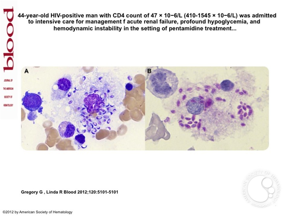Disseminated histoplasmosis complicating HIV infection