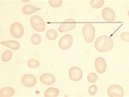 Pernicious Anemia - 1A