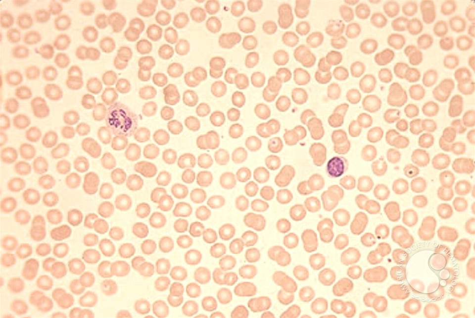 Pure Red Cell Aplasia (PRCA) –  parvovirus infection - 1.