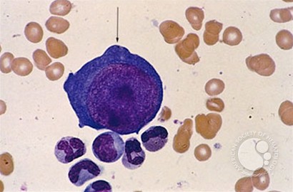 Pure Red Cell Aplasia (PRCA) –  parvovirus infection - 3.
