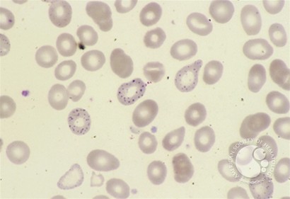 Red Blood Cell Diseases (RBC) 1 - 3.