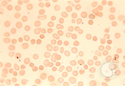 Red Blood Cell Diseases (RBC) 1 - 4.
