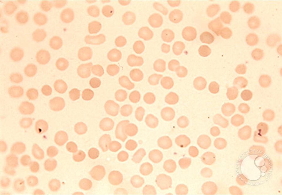 Red Blood Cell Diseases (RBC) 1 - 4.