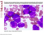 Hypergranular acute promyelocytic leukemia.