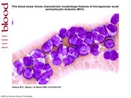 Microgranular acute promyelocytic leukemia (M3V).