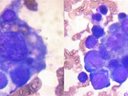 An unusual case of bone marrow involvement in a patient with Primary Mediastinal Germ Cell Tumor