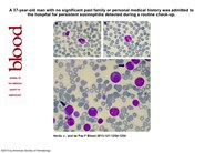 Chronic eosinophilic leukemia with FIP1L1-PDGFRA