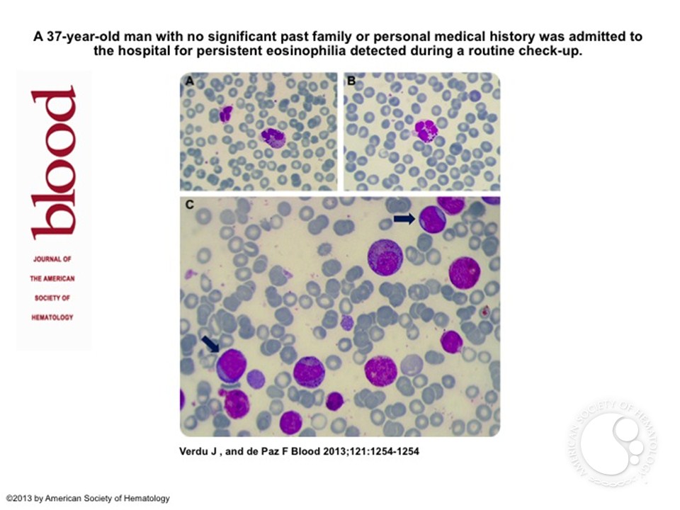 Chronic eosinophilic leukemia with FIP1L1-PDGFRA