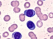 Plasma Cell Leukemia - 1.