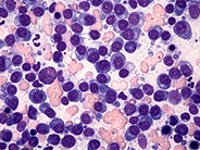 Plasma Cell Leukemia - 4.
