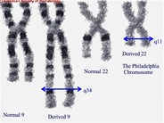 Acute Lymphocytic Leukemia - 8.