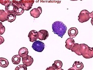 Acute Biphenotypic Leukemia - 1.