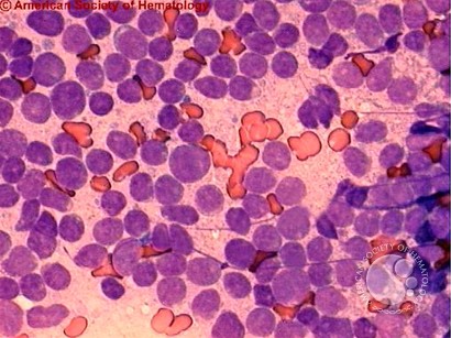 Acute Biphenotypic Leukemia - 2.