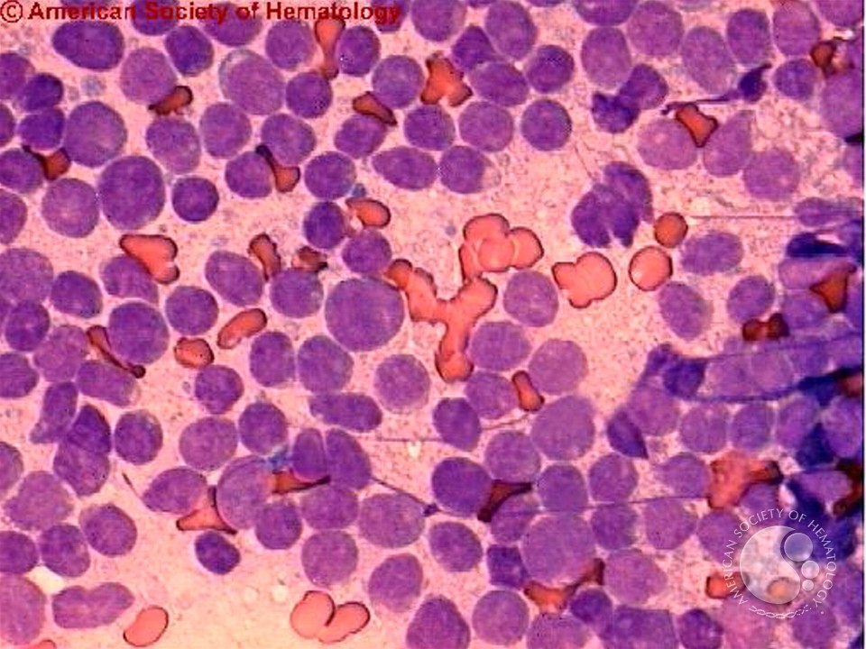 Acute Biphenotypic Leukemia - 2.