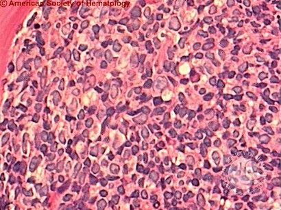 Acute Biphenotypic Leukemia - 5.