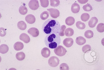 Pseudo Pelger Huet cells - 1.
