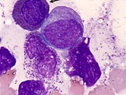 Eosinophilic myelocyte - 1.