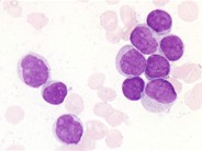 acute-myeloid-leukemia-without-maturation-1