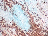 Anaplastic Large Cell Lymphoma - 1.