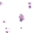 Neuroblastoma - pleural fluid - 2.