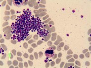 platelet clump in peripheral blood smear