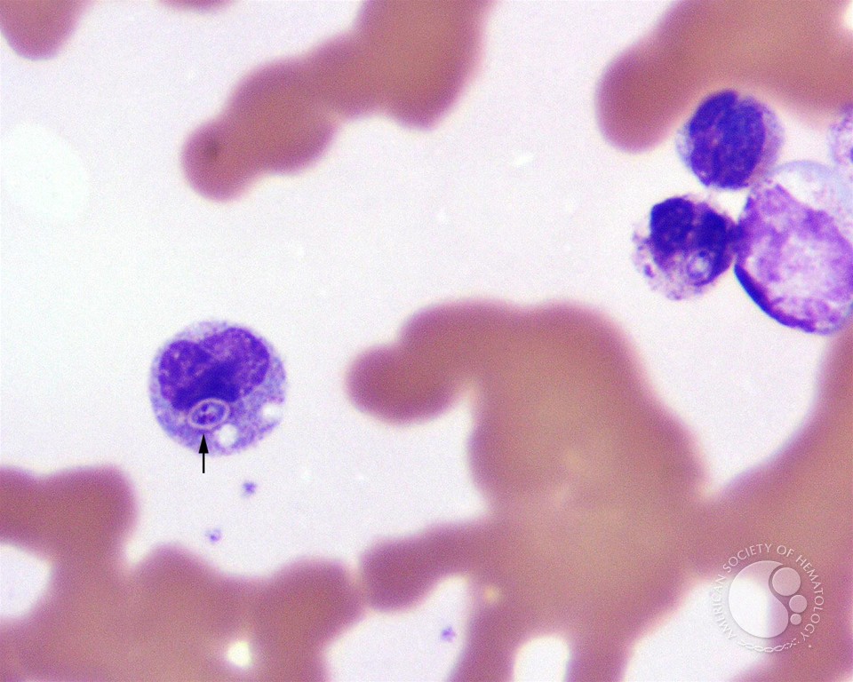 Fungal Inclusions in WBCs - 3.