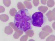 Alk Negative Anaplastic Large Cell Lymphoma Leukemic Phase