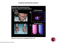 Congenital erythropoietic porphyria