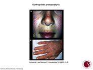 Erythropoietic protoporphyria