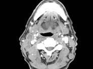 Paraneoplastic hypercalcemia in Diffuse Large B-Cell NHL - 1.